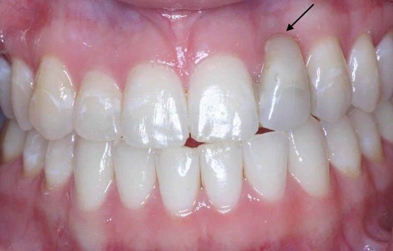 Ridge Augmentation Bone Grafting Tampa, FL Tampa Bay Periodontics