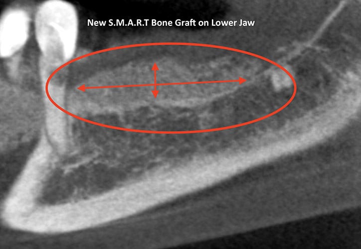Cone Beam CT Scan section of lower jaw (left side) after S.M.A.R.T. bone grafting.