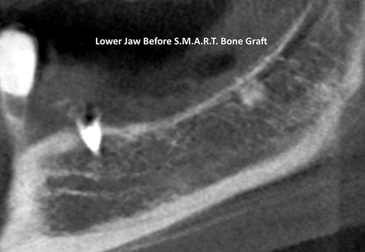 Cone Beam CT Scan section of lower jaw (left side) before S.M.A.R.T. bone grafting.