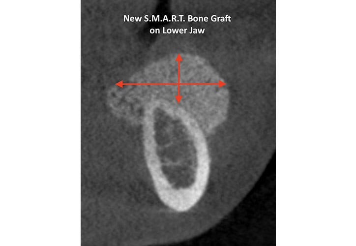 Cross section from Cone Beam CT Scan of the lower jaw after S.M.A.R.T. bone grafting.
