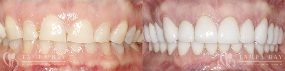 Restorative Crown Lengthening Before & After Patient 1-1