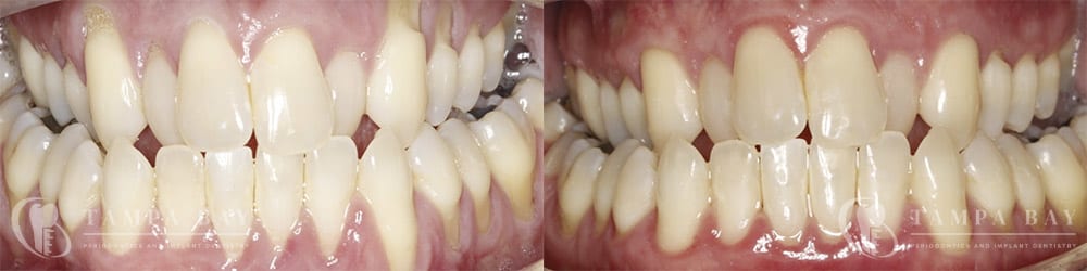 tampa-periodontics-adm-full-mouth-patient-1-1
