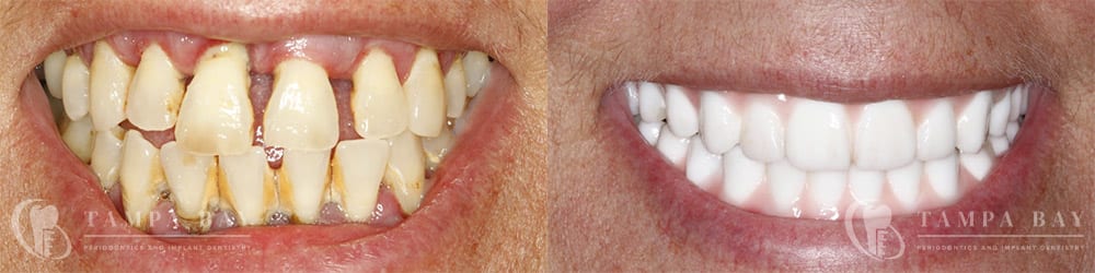 tampa-periodontics-full-arch-implants-patient-1-1