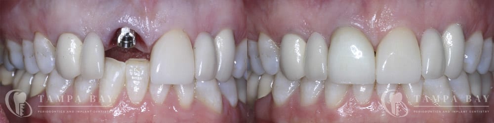 tampa-periodontics-immediate-implant-provisional-patient-1-1