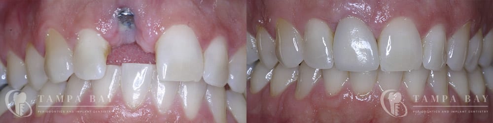 tampa-periodontics-malpositioned-implant-repair-patient-1-1