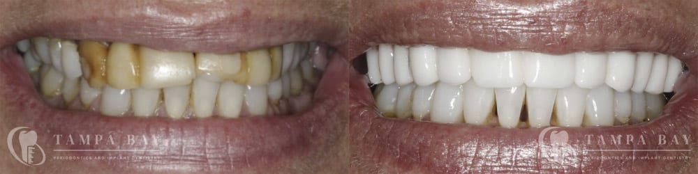 tampa-periodontics-upper-implants-patient-1-1